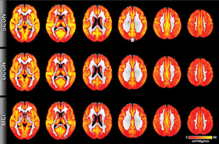 Illustration for article titled Brain Scans Show Signs Of Cognitive Decline Before Symptoms Appear